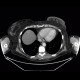 Liver metastasis, steatosis of liver, fatty liver, hepatopathy, correlation: CT - Computed tomography